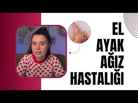 El Ayak ve Ağız Hastalığı Nedir? Nasıl Bulaşır? Kızamık ile Arasındaki Fark Nedir?